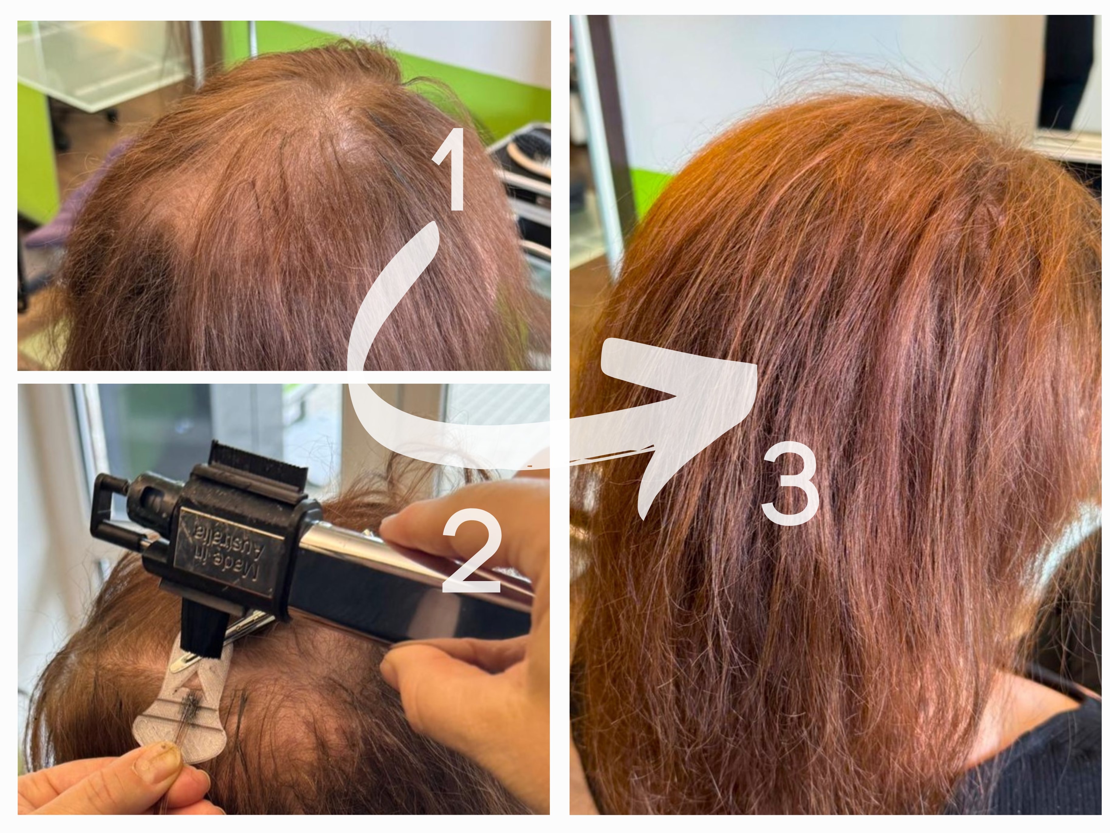 Der Weg zu vollem Haar mit combLine
